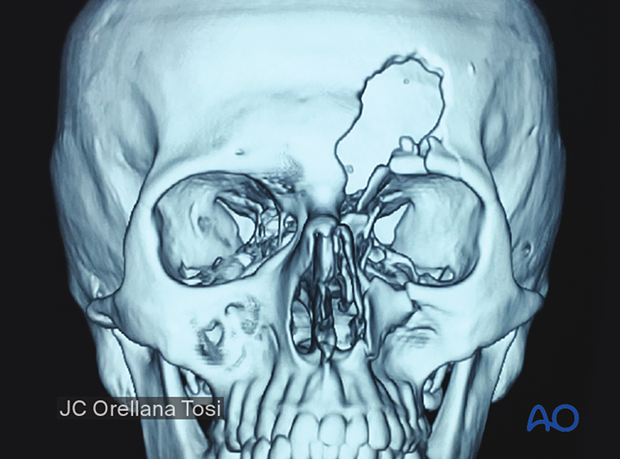 Diagnosis of NOE fractures