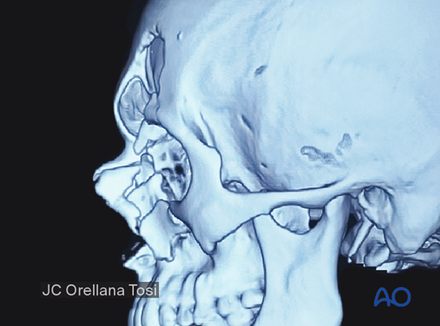 Diagnosis of NOE fractures