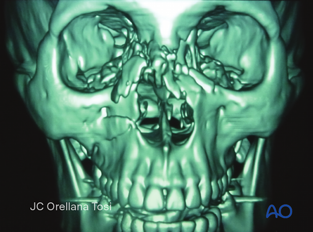 Diagnosis of fracture of the nasal bones