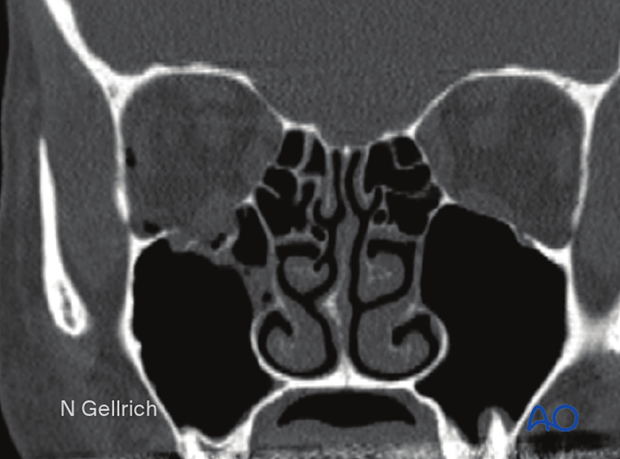 Orbital floor fracture
