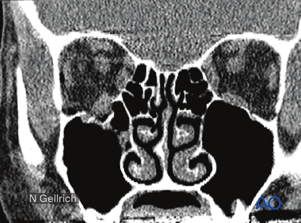 Orbital floor fracture
