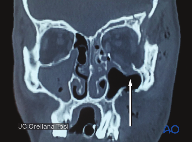 Orbital floor fracture