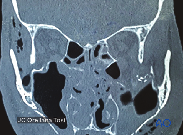 Orbital floor fracture