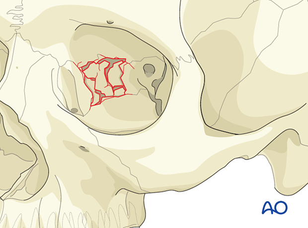 Medial orbital wall fracture