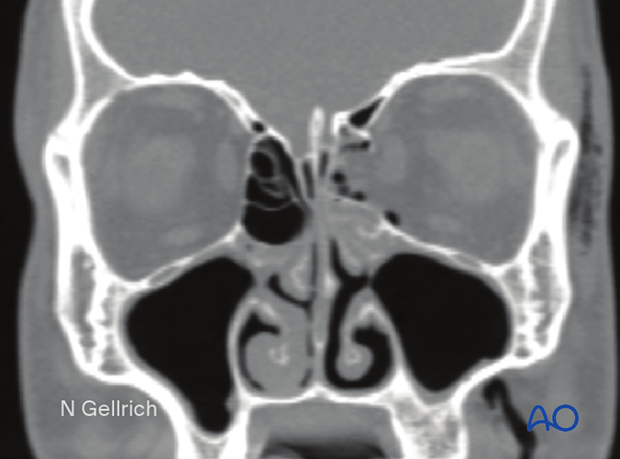 Medial orbital wall fracture