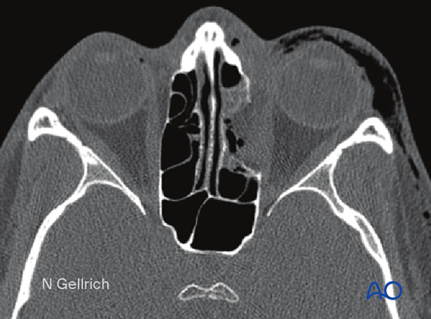 Medial orbital wall fracture 