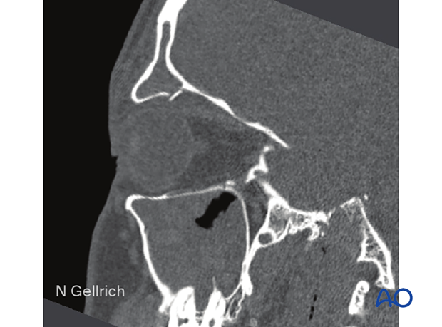 Orbital roof fracture