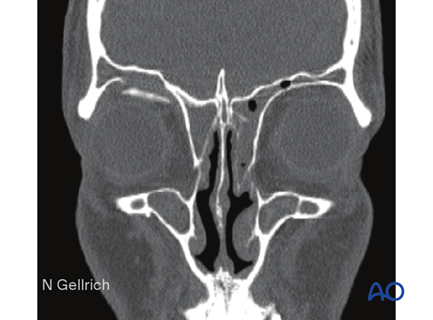 Orbital roof fracture