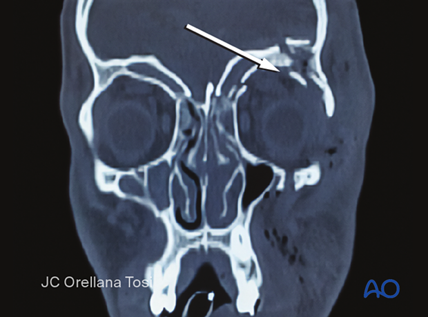 Orbital roof fracture
