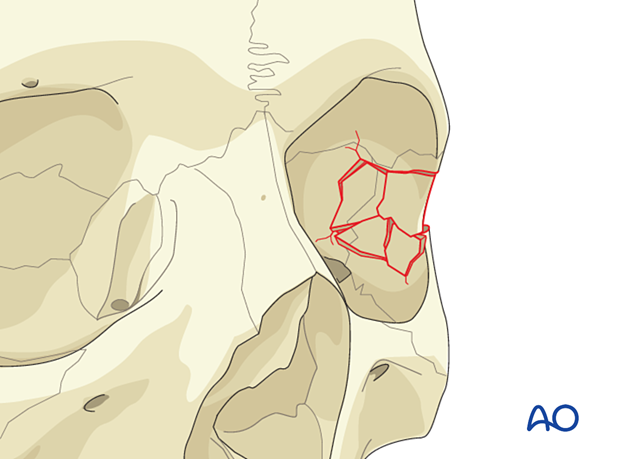 Lateral orbital wall fracture