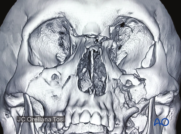 Combined orbital fractures