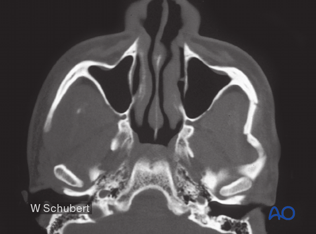 Zygomatic arch fracture