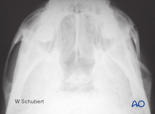 Zygomatic arch fracture