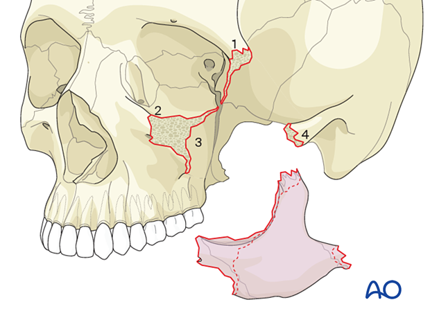 Zygoma fracture