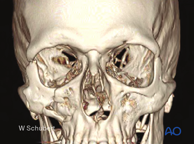 3D reconstruction of a right zygoma fracture