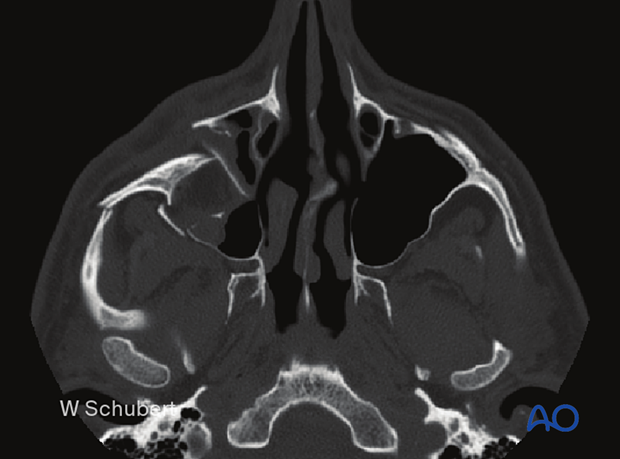Zygoma fracture - CT