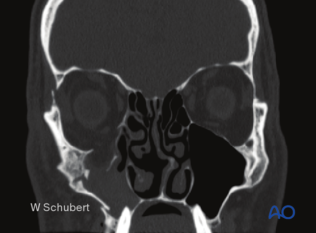 Zygoma fracture – CT showing internal orbital disruption and rotation of the zygoma in the coronal plane