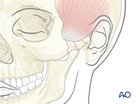Isolated zygomatic arch fracture