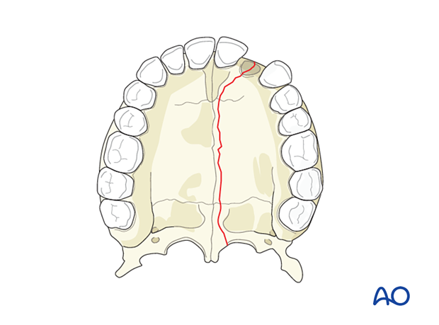 Palatoalveolar simple injury