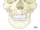 approach to the le fort i level of the midface in cleft lip and palate patients