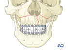 Palatoalveolar simple injury