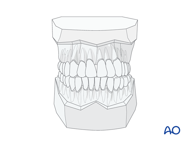 Palatoalveolar fracture, simple injury, closed treatment – palatal splint fabrication