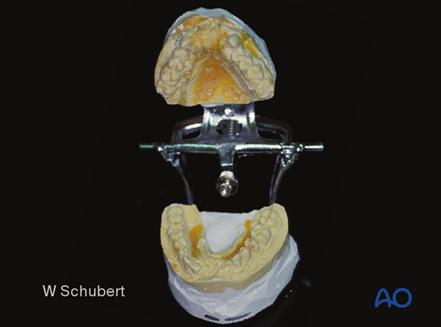 Palatoalveolar fracture, simple injury, closed treatment – palatal splint fabrication
