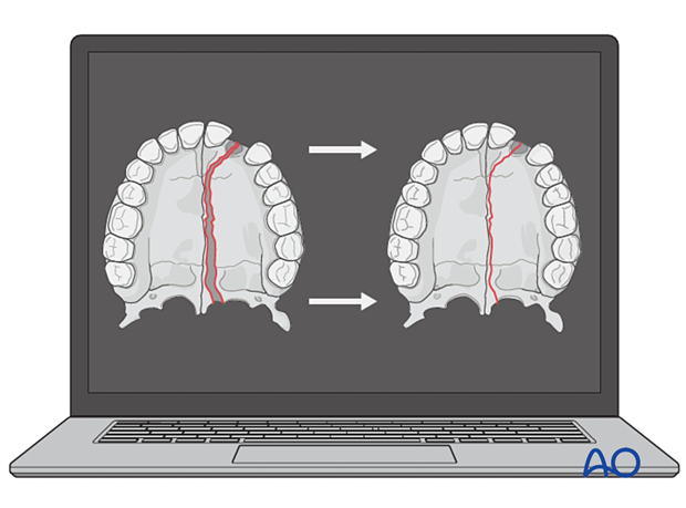 Palatoalveolar fracture, simple injury, closed treatment – palatal splint fabrication -1270045300