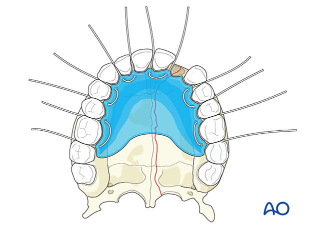 Palatoalveolar fracture, simple injury, closed treatment – palatal splint fixation