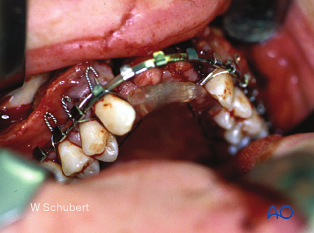 Palatoalveolar fracture, simple injury, closed treatment – palatal splint fixation
