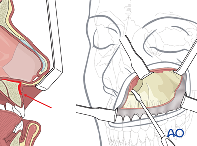 Open reduction internal fixation for Le Fort I fracture, unilateral ...