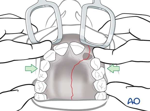 Palatoalveolar simple – open reduction internal fixation: reduction
