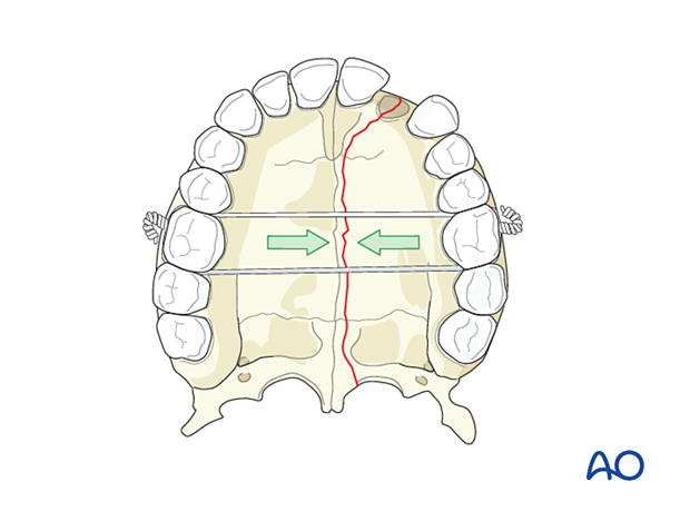 Palatoalveolar simple – open reduction internal fixation: reduction
