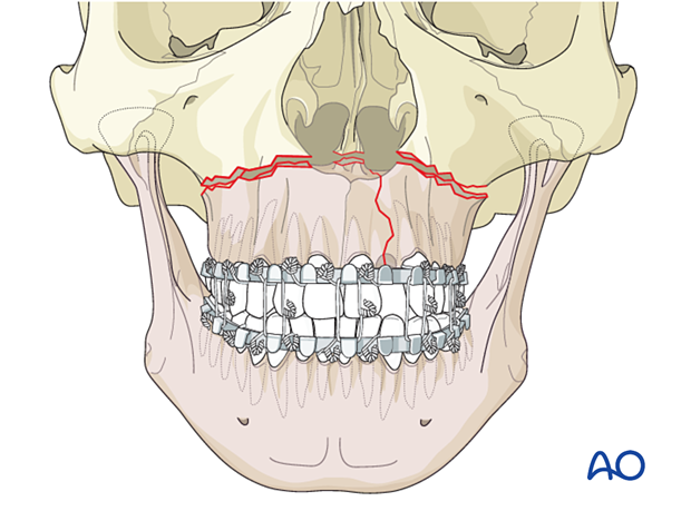 Palatoalveolar simple – open reduction internal fixation: apply MMF