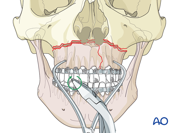 Palatoalveolar simple – open reduction internal fixation: apply MMF