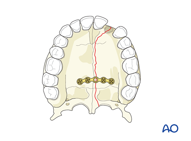 Palatoalveolar simple – open reduction internal fixation: fixation 
