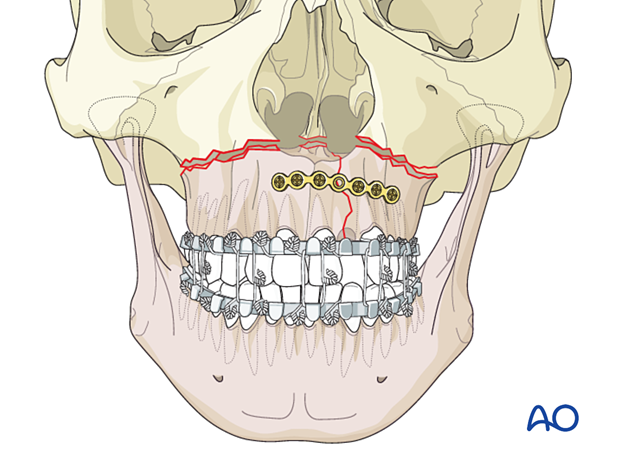 Palatoalveolar simple – open reduction internal fixation: fixation 