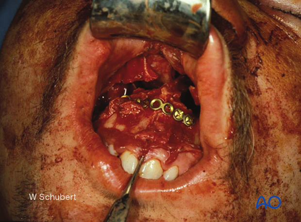 Palatoalveolar simple – open reduction internal fixation: fixation 