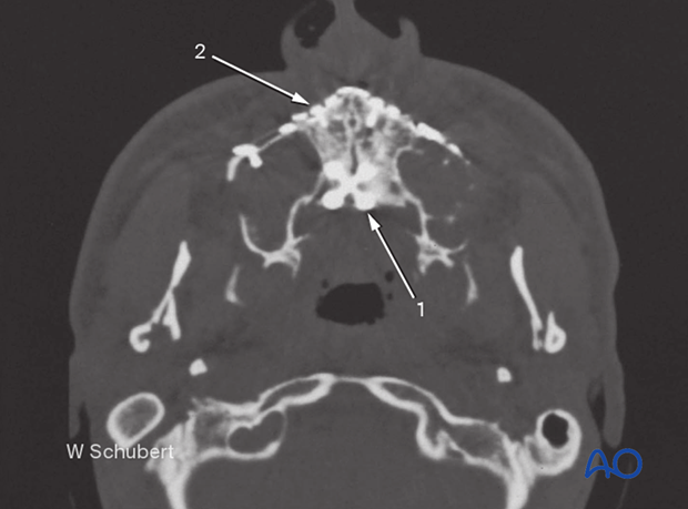 Palatoalveolar simple – open reduction internal fixation: fixation 