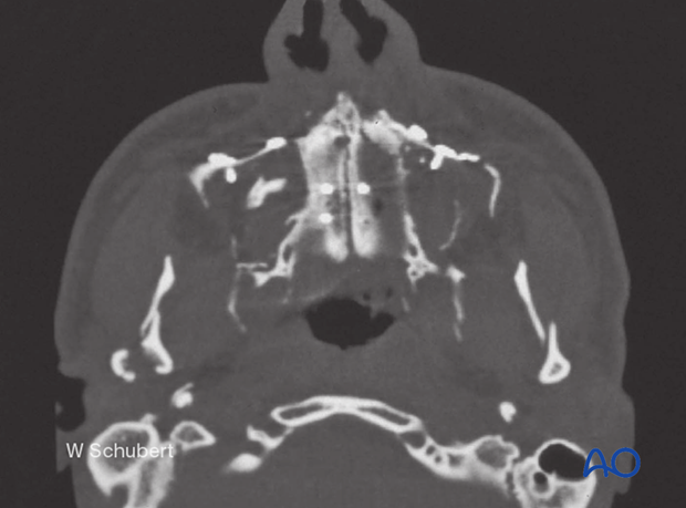 Palatoalveolar simple – open reduction internal fixation: fixation 