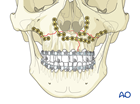 palatoalveolar simple injury