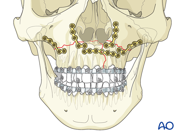 Palatoalveolar simple – open reduction internal fixation: fixation