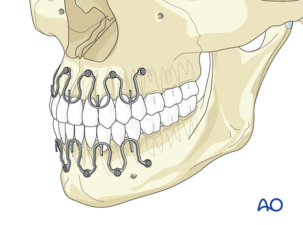 Palatoalveolar closed treatment – splint fixation and reduction 