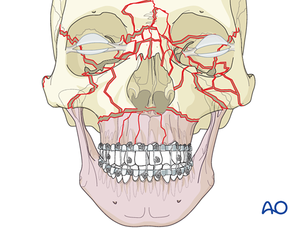 Palatoalveolar comminuted fracture, open reduction internal fixation: panfacial trauma