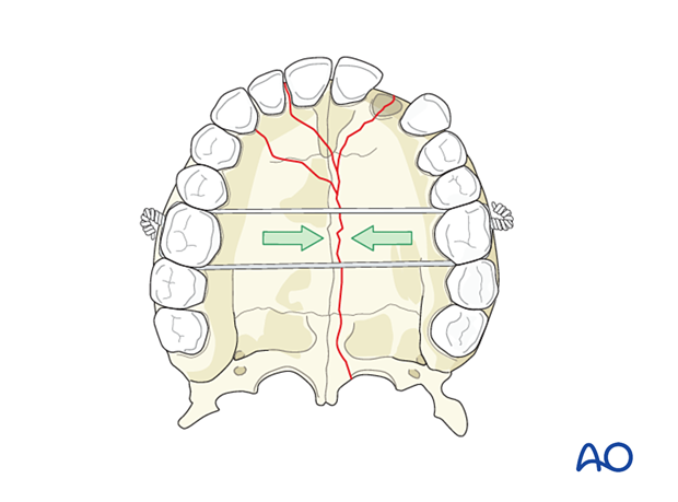 Palatoalveolar comminuted fracture, open reduction internal fixation: reduction