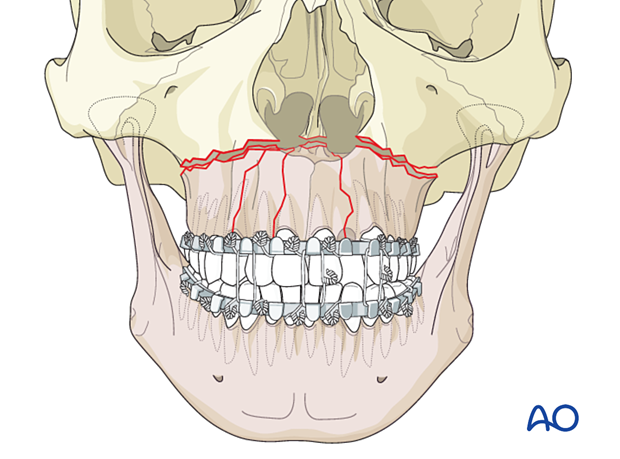 Palatoalveolar comminuted fracture, open reduction internal fixation: reduction