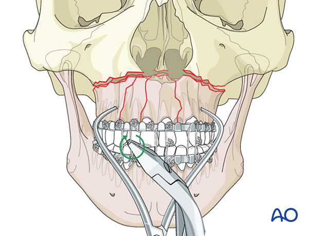 Palatoalveolar comminuted fracture, open reduction internal fixation: reduction