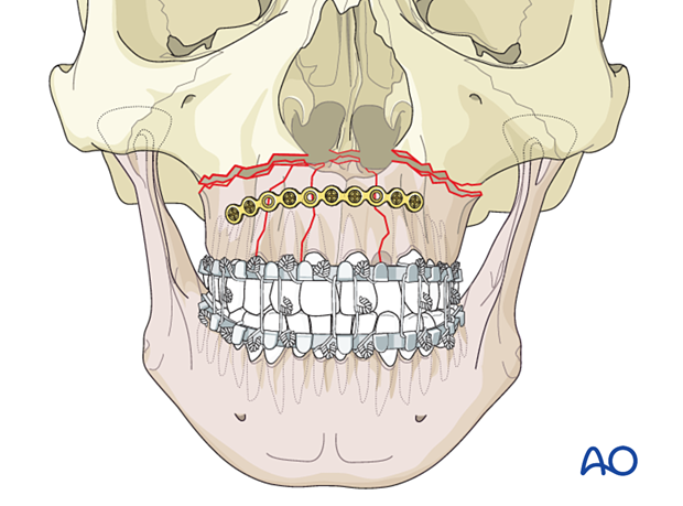 Palatoalveolar comminuted fracture, open reduction internal fixation: fixation