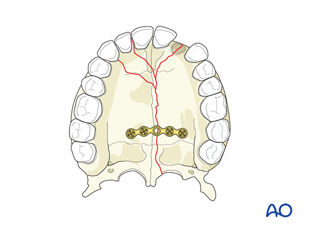 Palatoalveolar comminuted fracture, open reduction internal fixation: fixation 