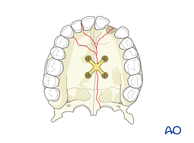 5370217308300 Palatoalveolar comminuted fracture, open reduction internal fixation: fixation